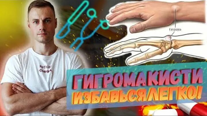Гигрома на руке фото лечение Гигрома: запястья, кисти, стопы лечение, причины Здоровье Инфо