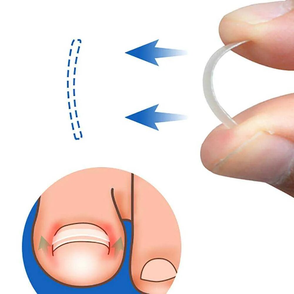 Сургитрон вросший ноготь. Обработка вросшего ногтя. Онихокриптоз воспаление. Онихокриптоз вросший ноготь. Онихоприктоз вросший ноготь.