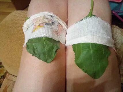 Лечение лопухом артроза коленного сустава