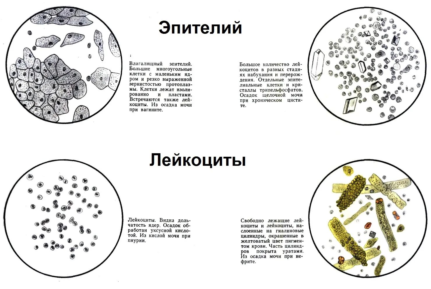 Лейкоциты микроскопия в моче норма. Эритроциты в моче микроскопия. Микроскопия мочи лейкоциты и эритроциты. Микроскопия осадка мочи лейкоциты норма.