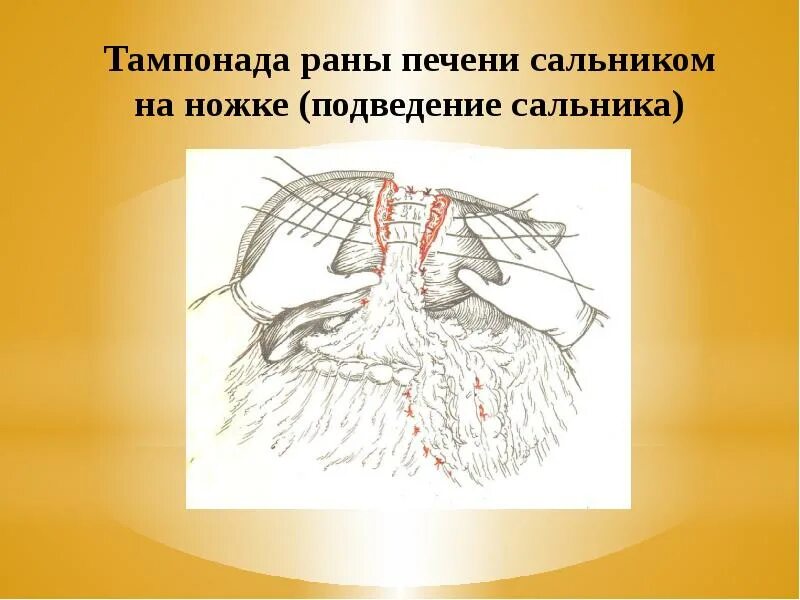 Тампонада раны при кровотечении. Тампонада печени сальником. Тампонада сальником на ножке. Тампонада сальником на ножке по Оппелю-Поликарпову.