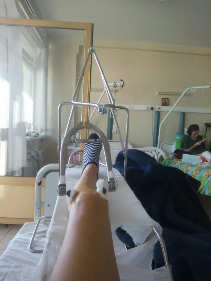 перелом бедра гипсование. сколько лежат в больнице с переломом бедра. деротационный гипсовый сапожок техника наложения.