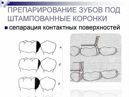 Препарирование это