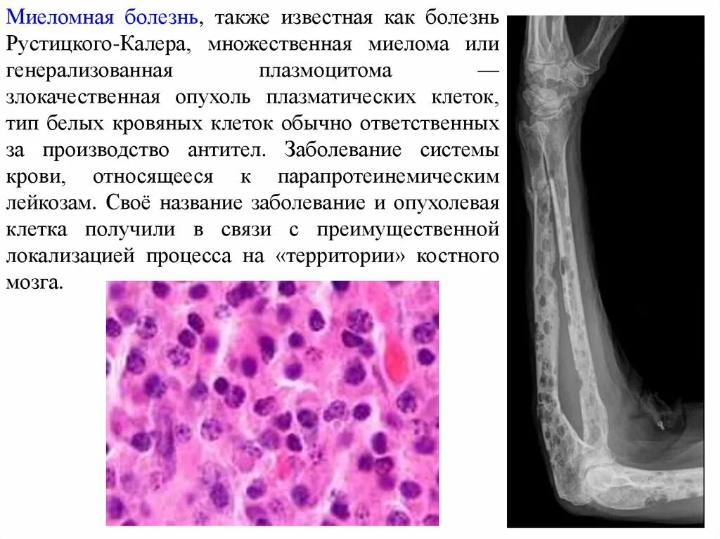 Множественная миелома и плазмоцитома. Множественная миелома патанатомия. Множественная миелома микропрепарат.