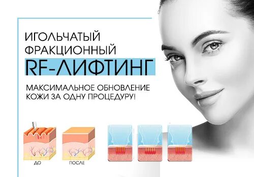 Игольчатый rf недорого skinlift ru