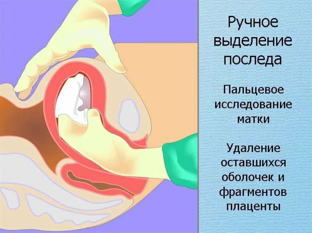 Ручное выделение плаценты. Ручное отделение и выделение последа. Ручное выделение последа. Ручное отделение плаценты и выделение.