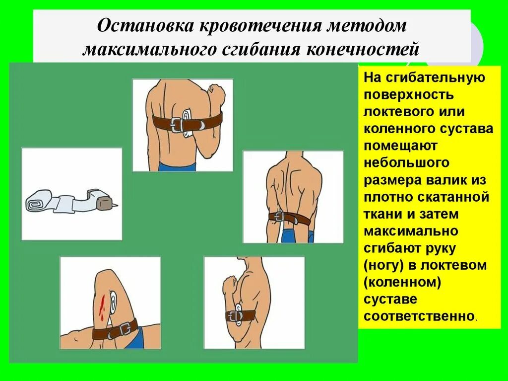 Способы остановки кровотечения лица. Остановка кровотечения сгибанием конечности. Остановка кровотечения максимальным сгибанием конечности алгоритм. Остановка кровотечения методом сгибания конечности алгоритм. Сгиб конечности для остановки кровотечения.