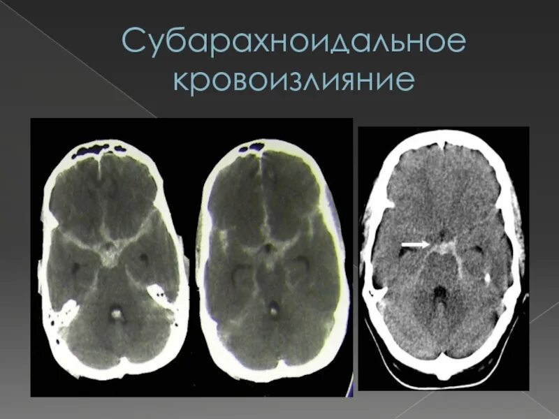 Субарахноидальный инсульт кт. Субарахноидальные кровоизлияния (Сак). Травматическое субарахноидальное кровоизлияние кт. Субарахноидальное инсульт клиника.