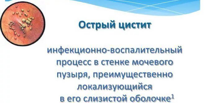 Симптомы острого цистита у женщин. Хронический геморрагический цистит. Острый геморрагический цистит. Геморрагический цистит у женщин. Острый геморрагический цистит симптомы.