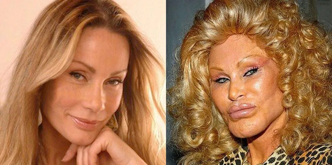 после пластической операции. джослин вильденштейн 1970. некдачеая поастика лицпп. женщина львица джоселин вильденштейн. дженис дикинсон жертва пластики.