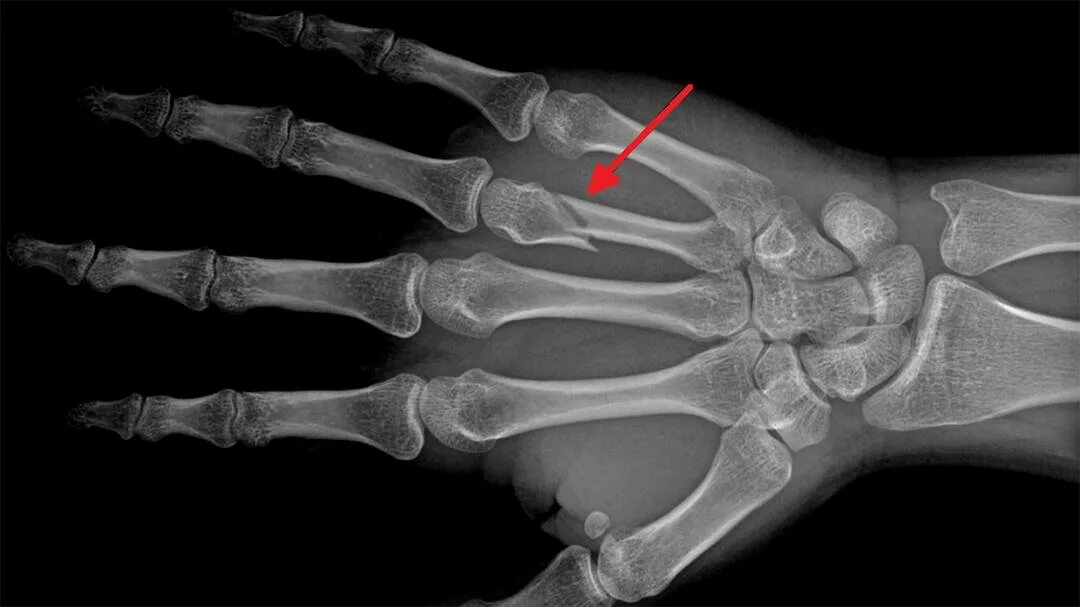 Fracture secind metacarpal Bone. Bones ray