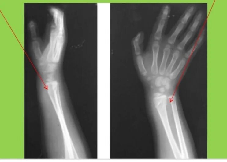Лучевая кость предплечья перелом. Перелом лучевой кости у детей в типичном месте. Остеомиелит лучевой кости рентген. Поднадкостничный перелом лучевой кости рентген.
