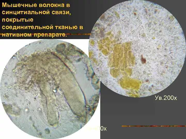 В копрограмме непереваренные. Микроскопия кала мышечные волокна. Копрология микроскопия.