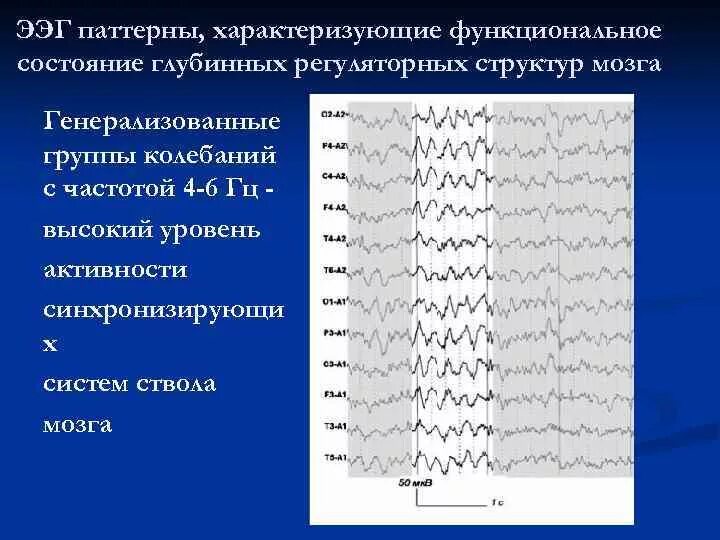 Дисфункция диэнцефальных структур. Легкая дисфункция диэнцефальных структур на ЭЭГ. Срединные структуры головного мозга на ЭЭГ. Функциональный паттерн ЭЭГ. ЭЭГ при разных болезнях.