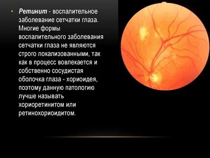 Ретинит