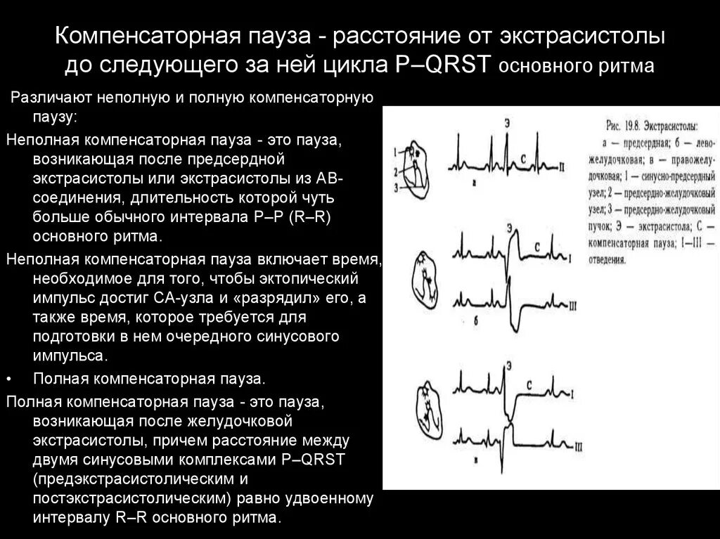 Компенсаторная экстрасистола