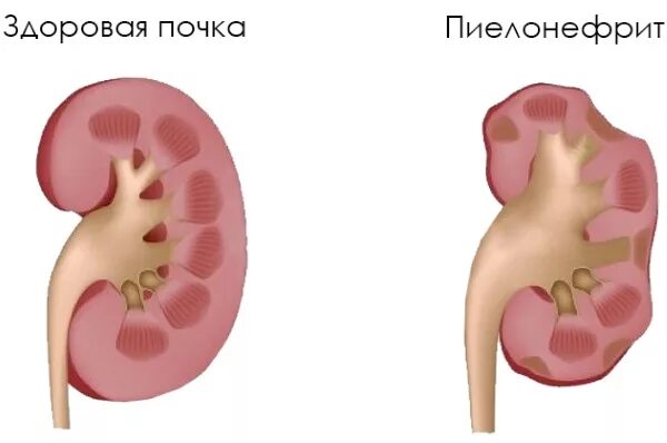 Пиелонефрит 1 триместр. Ангиомиолипома почки макропрепарат. ангиолипома почки 5.5. хронический пиелонефрит.