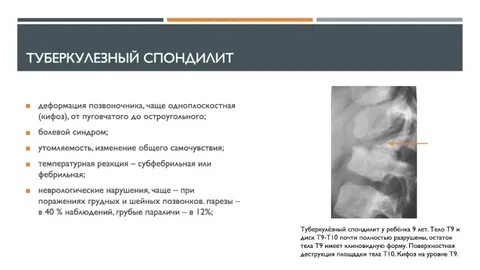 Туберкулезный сайт