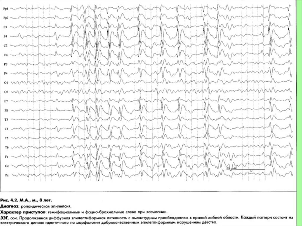 Роландическая эпилепсия ЭЭГ. Роландические комплексы на ЭЭГ. Роландические спайки на ЭЭГ. Роландические спайки на ЭЭГ У ребенка. Идиопатическая генерализованная эпилепсия