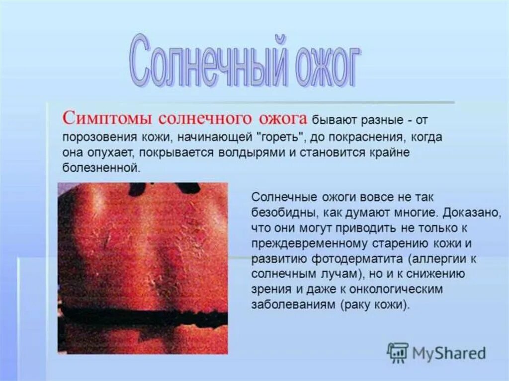 После того как сгорел. Симптомы солнечного ожога.