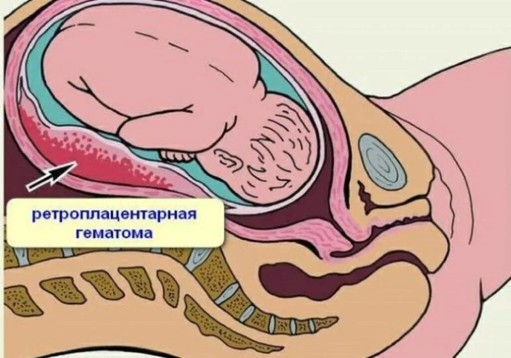 Ретроплацентарная гематома образуется. Ретроплацентарная заоболочечная гематома. Ретроплацентарная и ретрохориальная гематомы. Ретроплацентарная гематома что с маткой. При беременности ощущается матка