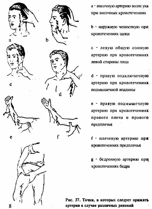 Остановка кровотечения из височной артерии. Способы остановки крови при ранении головы. Способы остановки кровотечения на голове. Остановка кровотечения при ранении головы.