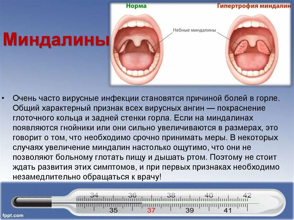 Моноклиоз. Герпетическая ангина гнойная ангина. Хроническая герпесная ангина.