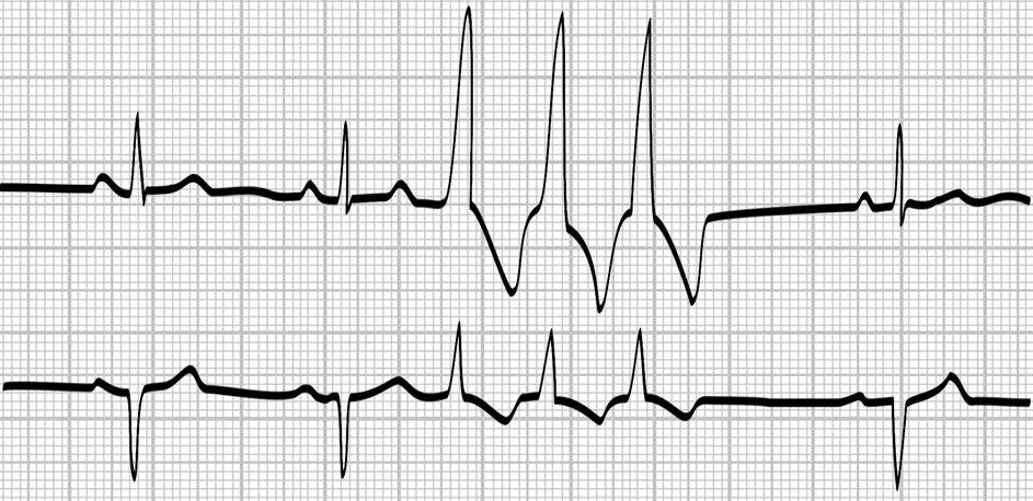 Наджелудочковая экстрасистолия бигеминия ЭКГ. Фибрилляция предсердий брадисистолическая форма на ЭКГ. Мерцательная экстрасистолия на ЭКГ. Наджелудочковая экстрасистолия на ЭКГ. Экстрасистолы врачам