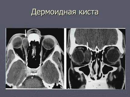Киста 21 мм