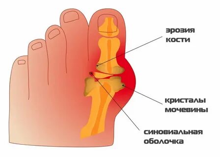 Болят основания больших пальцев на ногах