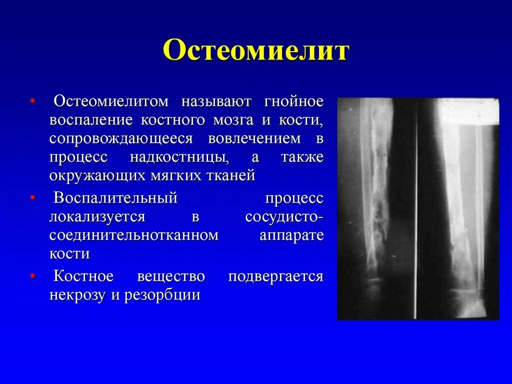 Остеомиелит посттравматический костей,рентген. Хронический остеомиелит большеберцовой кости кт. Рентген острого травматического остеомиелита. Остеомиелит большеберцовой кости кт. Гнойные заболевания костей