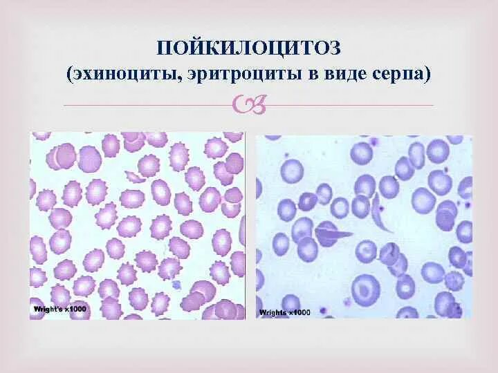 Пойкилоцитоз анемия. Пойкилоцитоз формы эритроцитов. Патологический пойкилоцитоз.. Пойкилоцитоз эхиноциты. Формы эритроцитов эхиноциты.