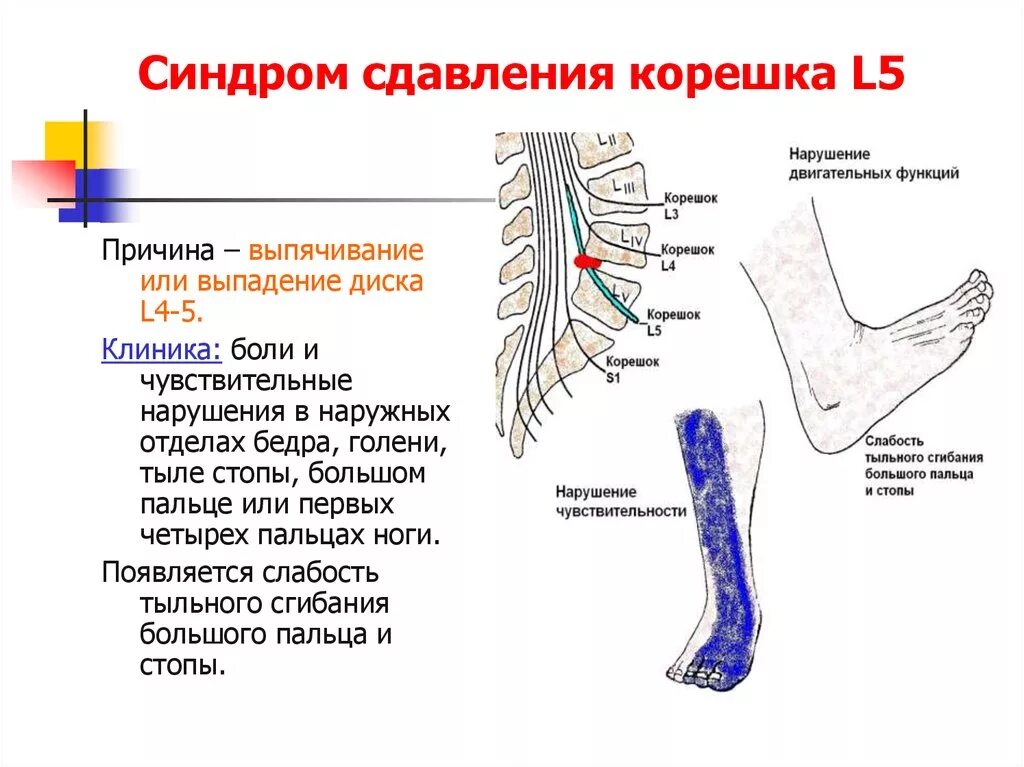 Поражение корешковых нервов. Синдром компрессии корешка l5. Компрессии корешка l5 или s1. Симптомы поражения l4 корешка. Симптомы компрессии Корешков l4.