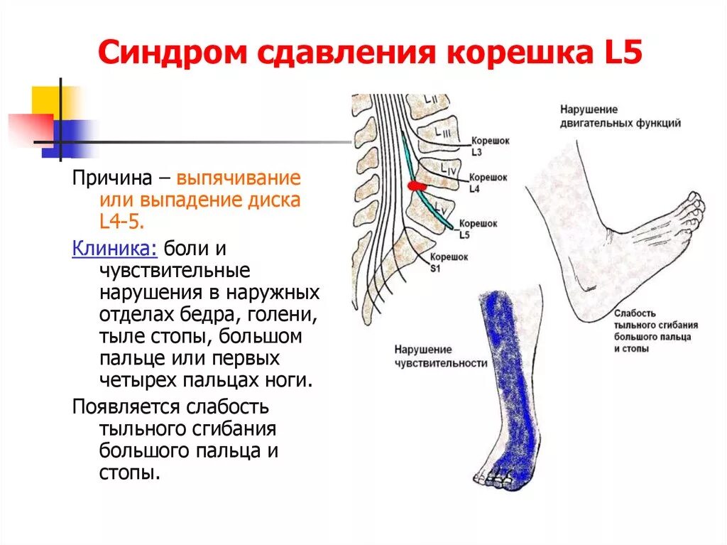 Корешковое поражение. Синдром компрессии корешка l5. Компрессии корешка l5 или s1. Симптомы поражения l4 корешка. Симптомы компрессии Корешков l4.