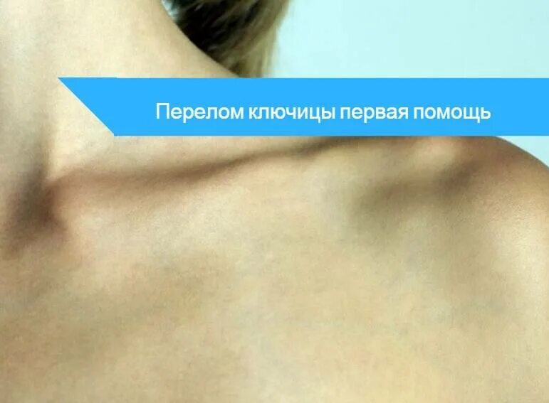 Перелом ключицы рентгеносемиотика. Предгрудинный вывих ключицы. Восстановление ключицы. Перелом ключицы показания. Перелом ключицы симптомы.