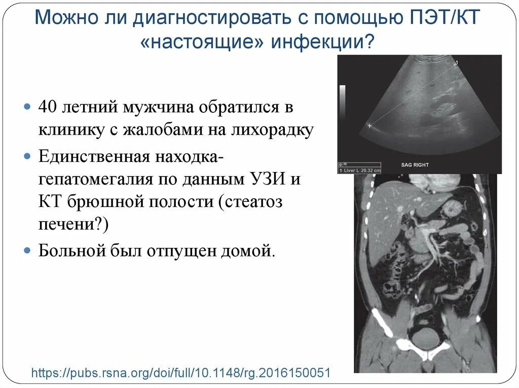 ПЭТ органов брюшной полости. ПЭТ кт диета. Диета при ПЭТ кт подготовке. Питание перед ПЭТ кт исследование. Что можно перед пэт кт с контрастом