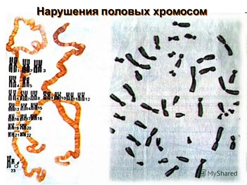 Заболевания связанные с изменением числа половых хромосом. Заболевания связанные с аномалиями половых хромосом. Кариотип больного с синдромом клайнфельтера. Болезни связанные с нарушением числа хромосом. Хромосомных нарушений половых.