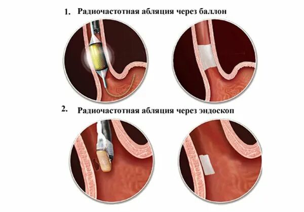 Абляция пищевода. Радиочастотная катетерная абляция. Абляция пищевода Баррета. Радиочастотная катетерная абляция (РЧА).