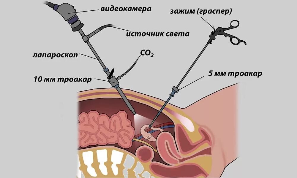 Лапароскопия это. Лапароскопия кист яичников. лапароскопия в гинекологии пункция. лапароскопическая резекция яичника. лапароскопия шейку матки.