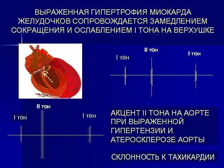 Сокращение стенок предсердий