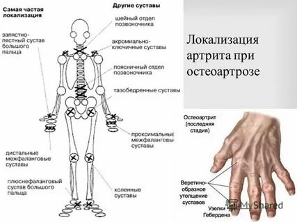 Остеоартроз межфаланговых суставов