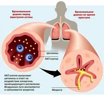 Бронхи при приступе бронхиальной астмы