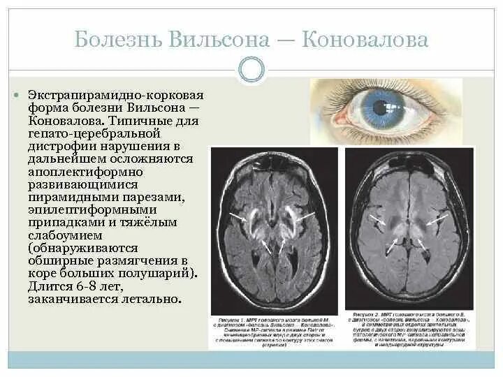 Синдром вильсона коновалова что это такое простыми. Вильсона Коновалова болезнь диагностика. Болезнь Вильсона — Вестфаля — Коновалова. Болезнь Вильсона Коновалова фенотип. Мрт при болезни Вильсона-Коновалова.