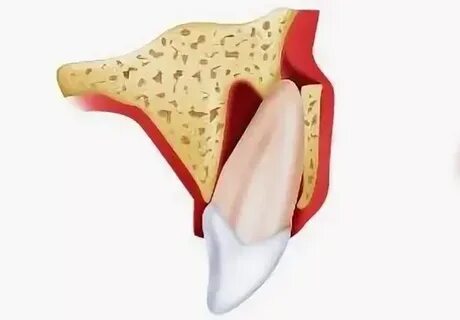 Люксация зуба