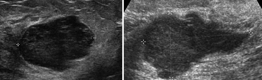 Фиброма в груди. Фиброаденома молочной железы УЗИ снимок. Листовидная фиброаденома на УЗИ. Листовидная фиброаденома молочной на УЗИ. Филлоидная опухоль молочной железы УЗИ.