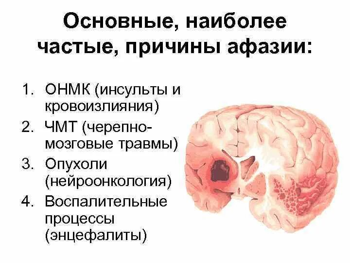 Афазия ОНМК. Причины возникновения афазии. Острое нарушение мозгового кровообращения. Причины острых нарушений мозгового кровообращения.