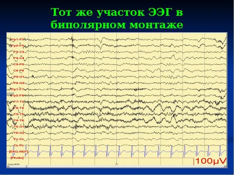 Ээг тверь. ЭЭГ. Артефакты ЭЭГ. ЭЭГ сигнал. ЭЭГ головного мозга.