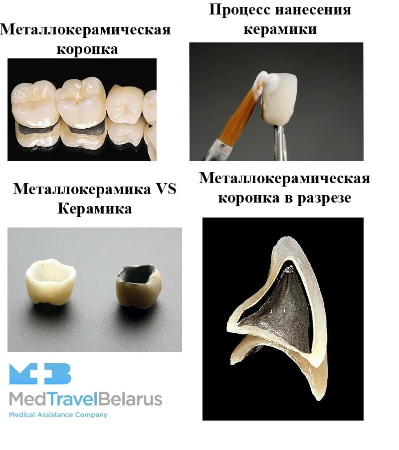 Лабораторные этапы металлокерамической коронки