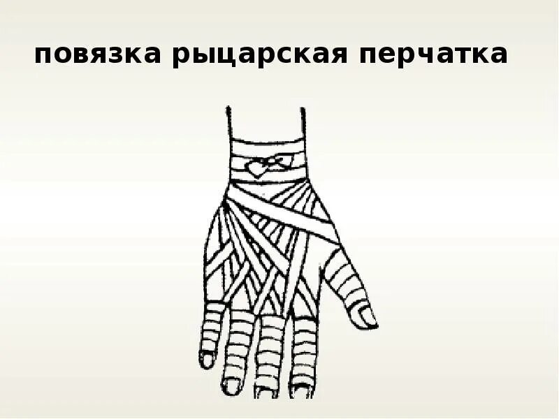 Техника наложения повязки перчатка. Бинтование Рыцарская перчатка. Рыцарская перчатка десмургия. Перевязка Рыцарская перчатка алгоритм. Десмургия повязка перчатка.