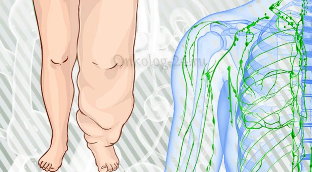 Лимфедема (лимфатический отек, лимфостаз). Лимфоузлы в паху воспаление причины лечение